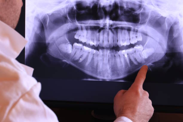 Best Knocked-Out Tooth (Avulsed Tooth) Treatment in Clayton, NJ